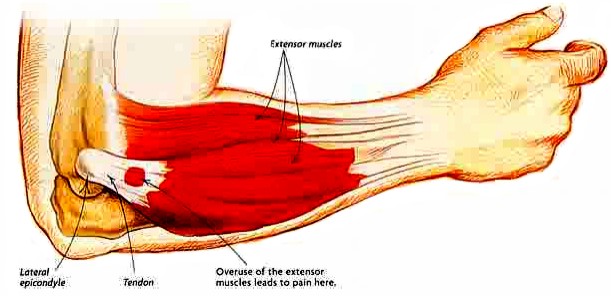 Muscles that move the forearm. Diagram Of The Muscles In The Forearm : Common Sports Injuries and How to Avoid Them | 4Ever Fitness